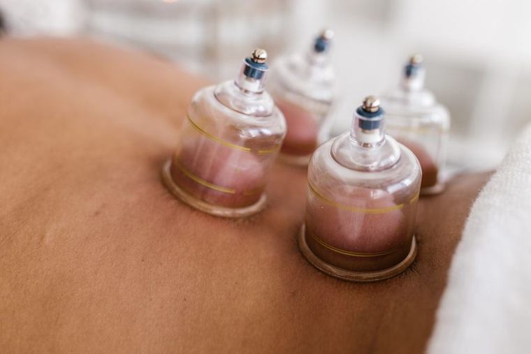 Cupping-glazen op de rug tijdens een behandeling